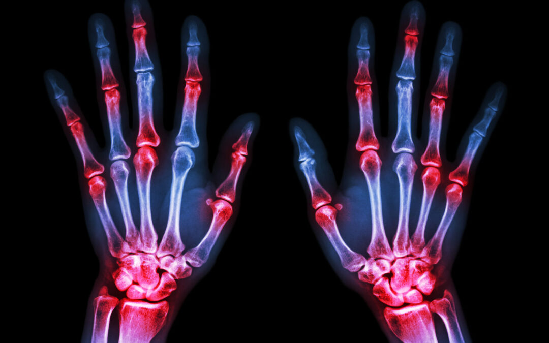 Rheumatoid Arthritis: Autoimmune disease 2.5 times more common in women