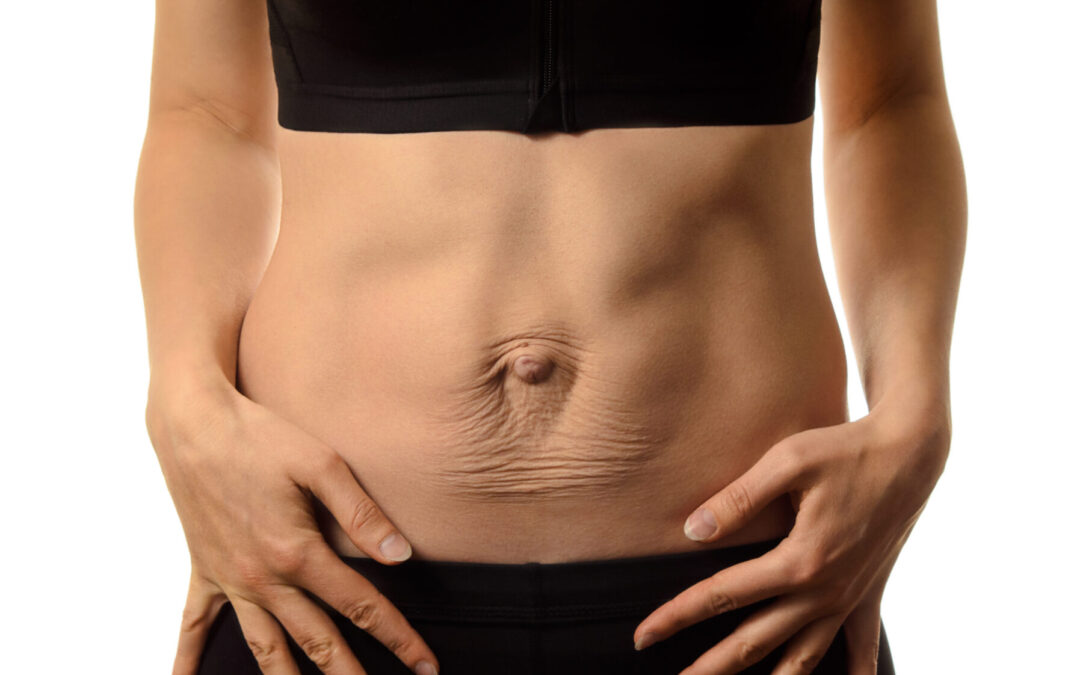 The truth about diastasis rectus abdominis